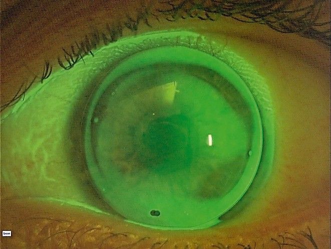 Limbusnahe Kontaktlinsen, Teil 2