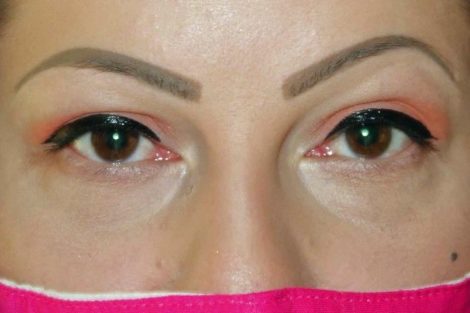 Augenentzündungen beim Kontaktlinsenträger