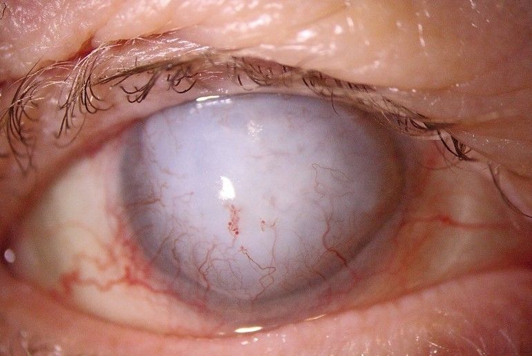 Prothetische Kontaktlinsenversorgung mit einer Irisprint-Sklerallinse