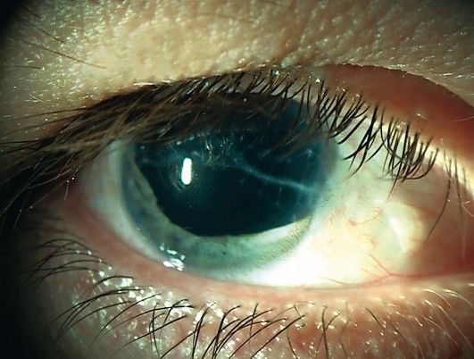 Formstabile Iris-Kontaktlinse