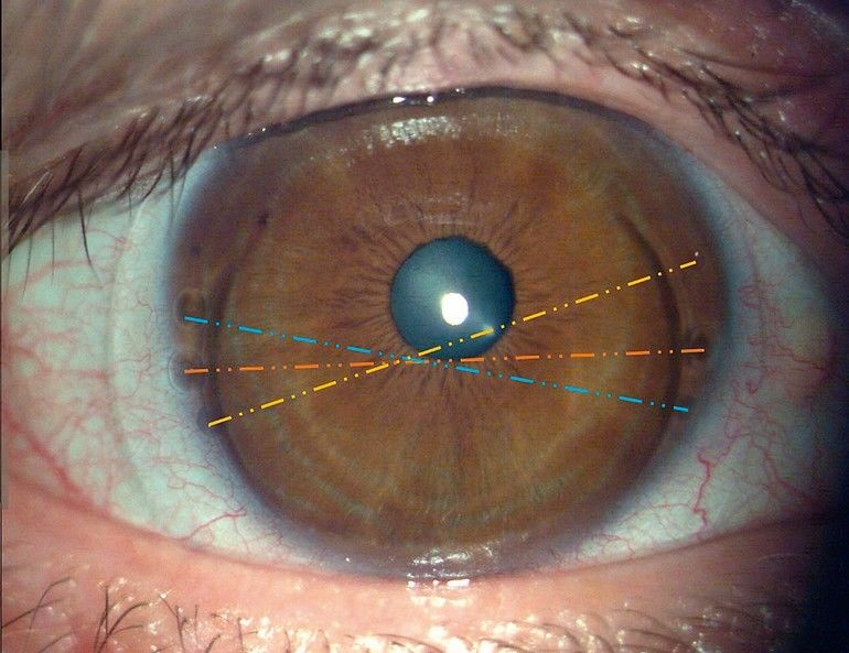 Weiche torische Kontaktlinsen bei Astigmatismus