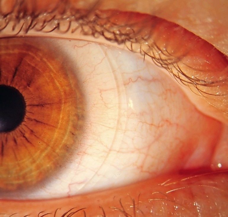 Herausforderung: Komplikationen durch das Tragen von Kontaktlinsen