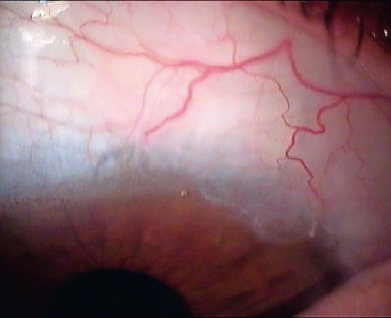 Anpassung von formstabilen, cornealen Kontaktlinsen nach Trabekulektomie