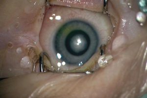 Anpassung von Kontaktlinsen bei Neugeborenen