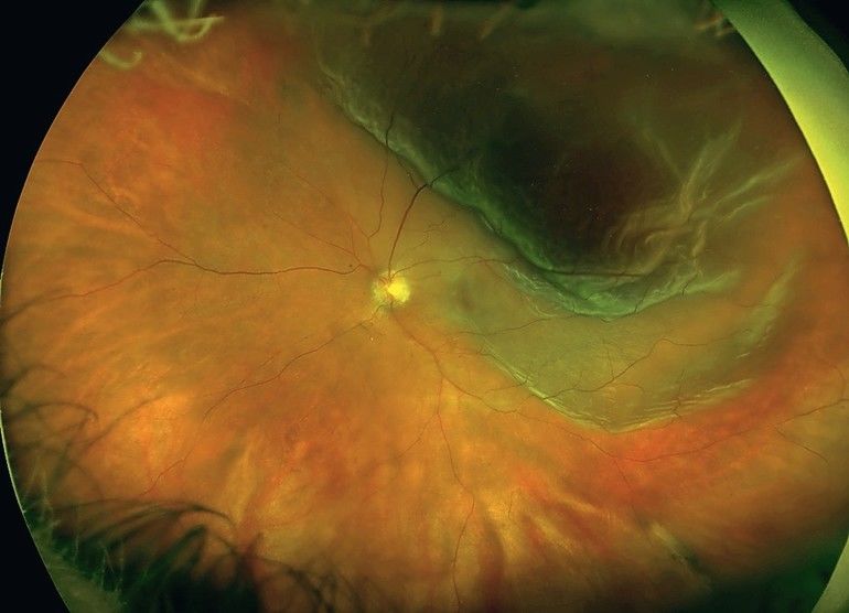 Myopiebedingte pathologische Veränderungen am Auge