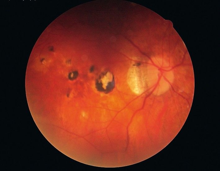 Weichlinsenversorgung bei hoher Myopie, Amblyopie und Marfan-Syndrom
