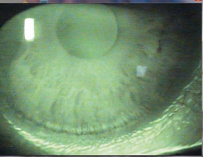 Kontaktlinseninduzierte corneale periphere Komplikationen (Teil 2)