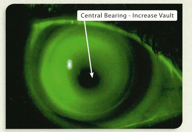 Die schwere Geburt der Hybrid-Kontaktlinse