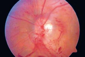 Das metabolische Syndrom und Augenerkrankungen